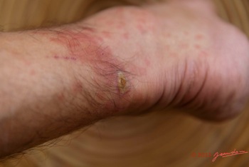 LOANGO-Inyoungou-Ampoule-et-Piqures-Insectes-sur-le-Pied-de-JLA-12E5K2IMG_79619wtmk-Web